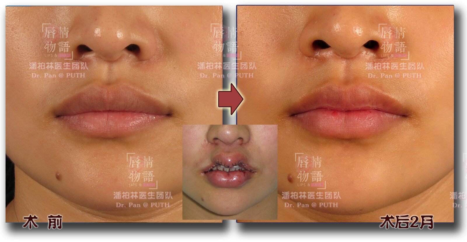 上唇綜合整形(upper lip vermilion plasty):修薄/m唇/Ω唇