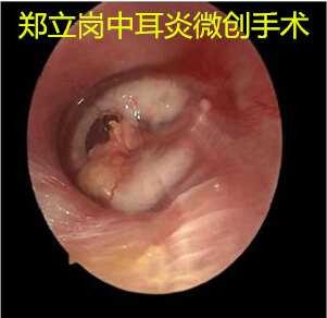 鼓膜变白变硬了 该怎么办 鼓膜穿孔 鼓膜穿孔