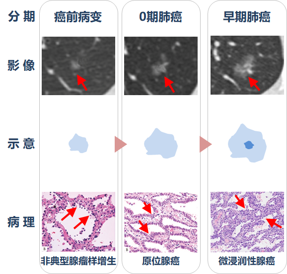 肺原位腺癌 Ais 和微浸润腺癌 Mia 是否一定不复发 最新长期预后数据来了 肺癌 好大夫在线