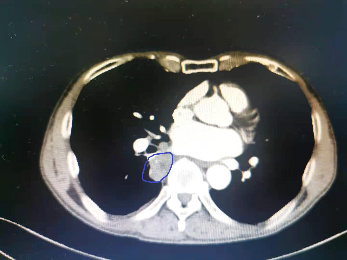 单个肺部结节肺部肿块怎么办