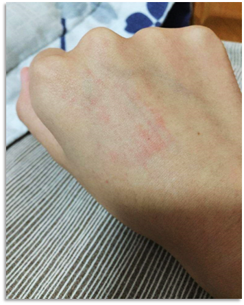 此种情况需立即接种疫苗并对伤口进行局部处理.