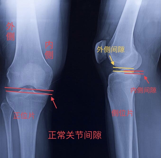 膝关节x线正常图片图片