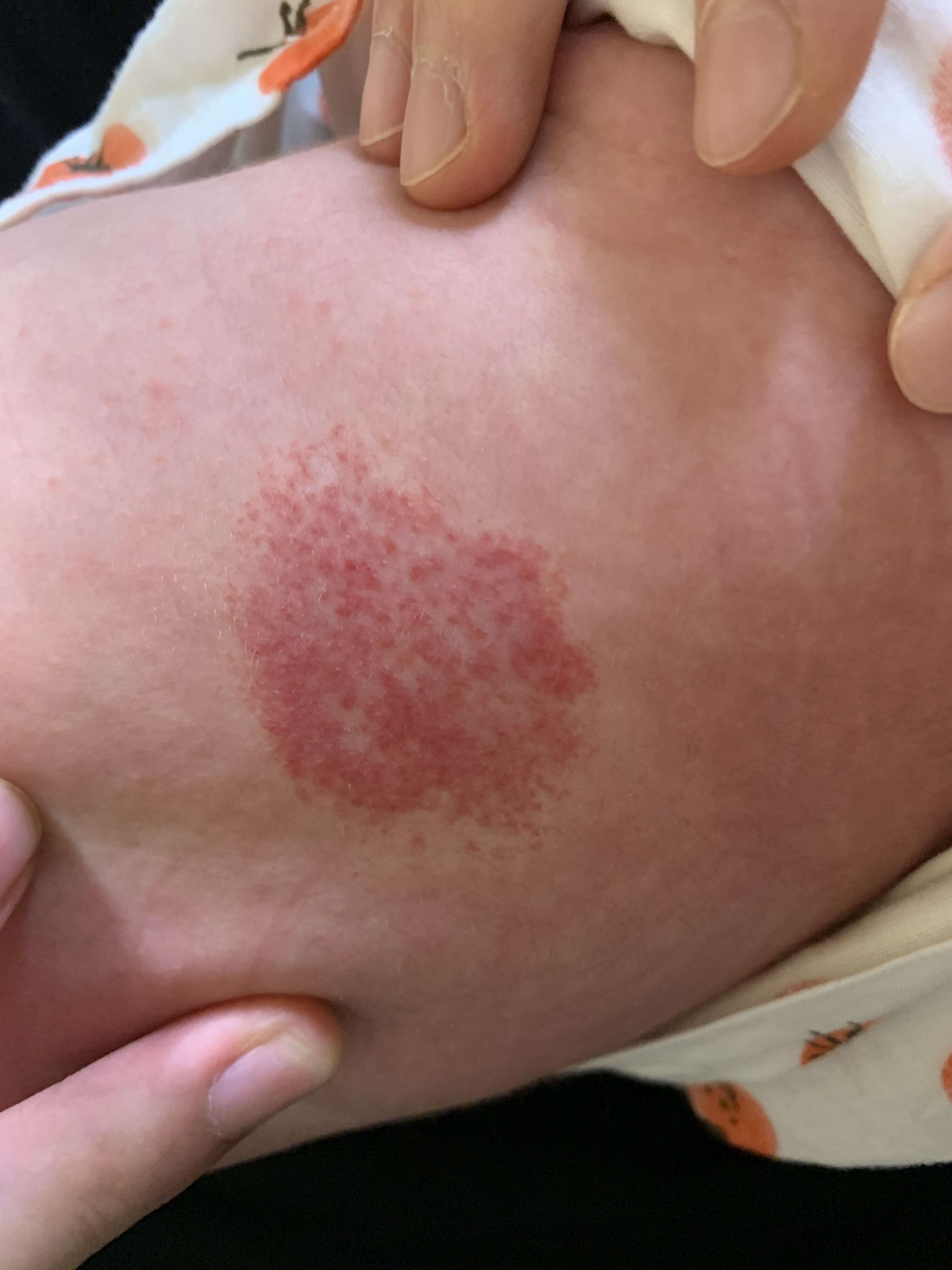 儿童血管瘤医学科普_婴幼儿血管瘤_症状表现_治疗方式 - 好大夫在线