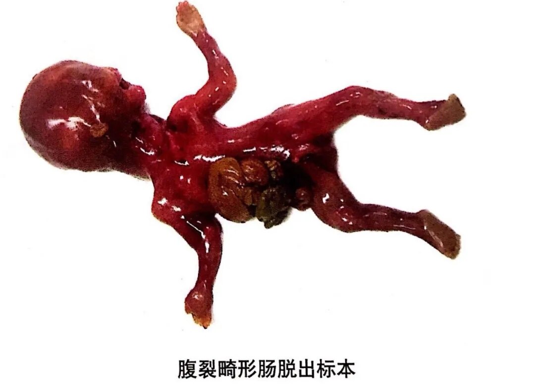 胎儿腹裂图片