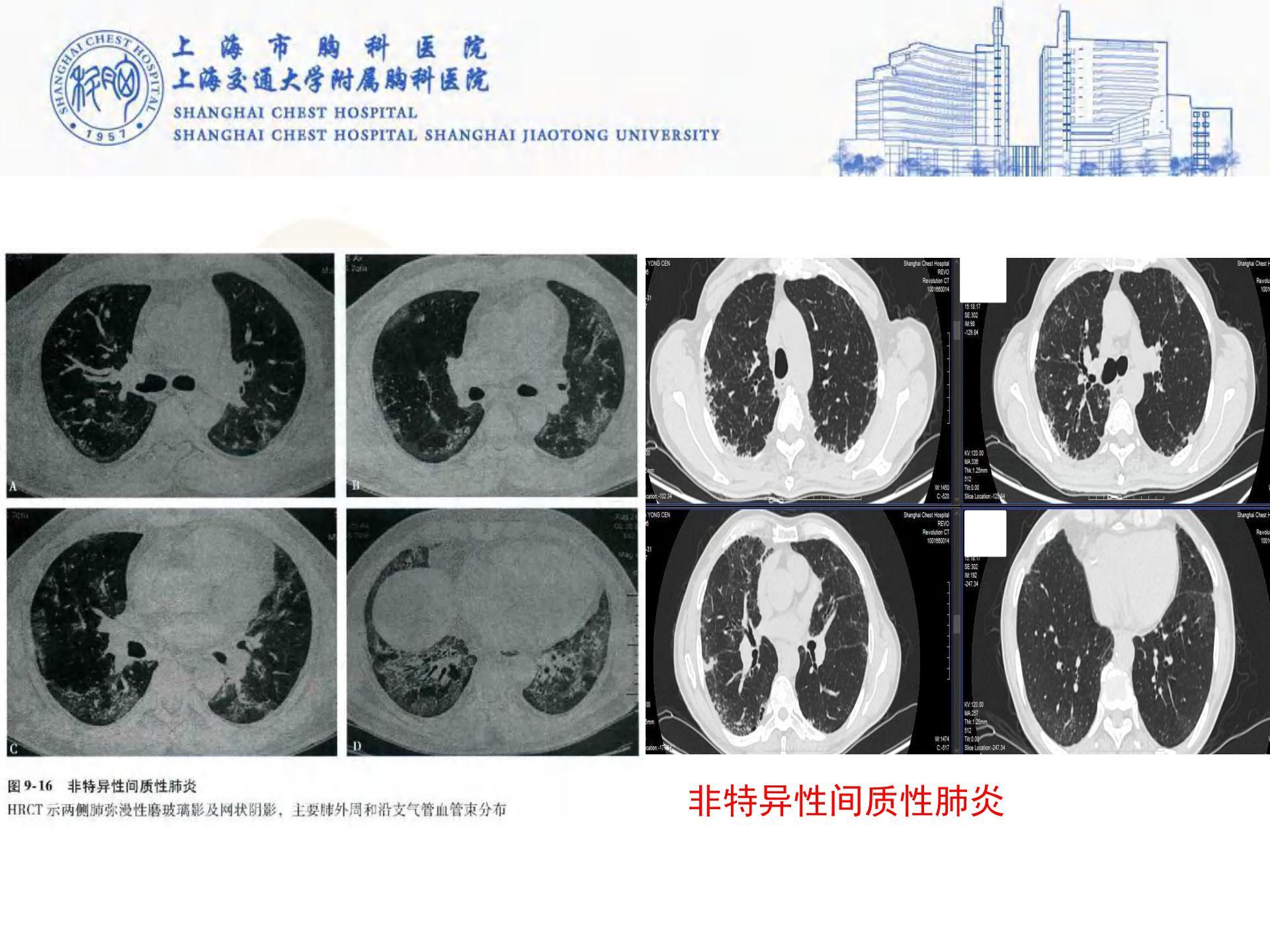 我是如何诊断间质性肺病 - 好大夫在线