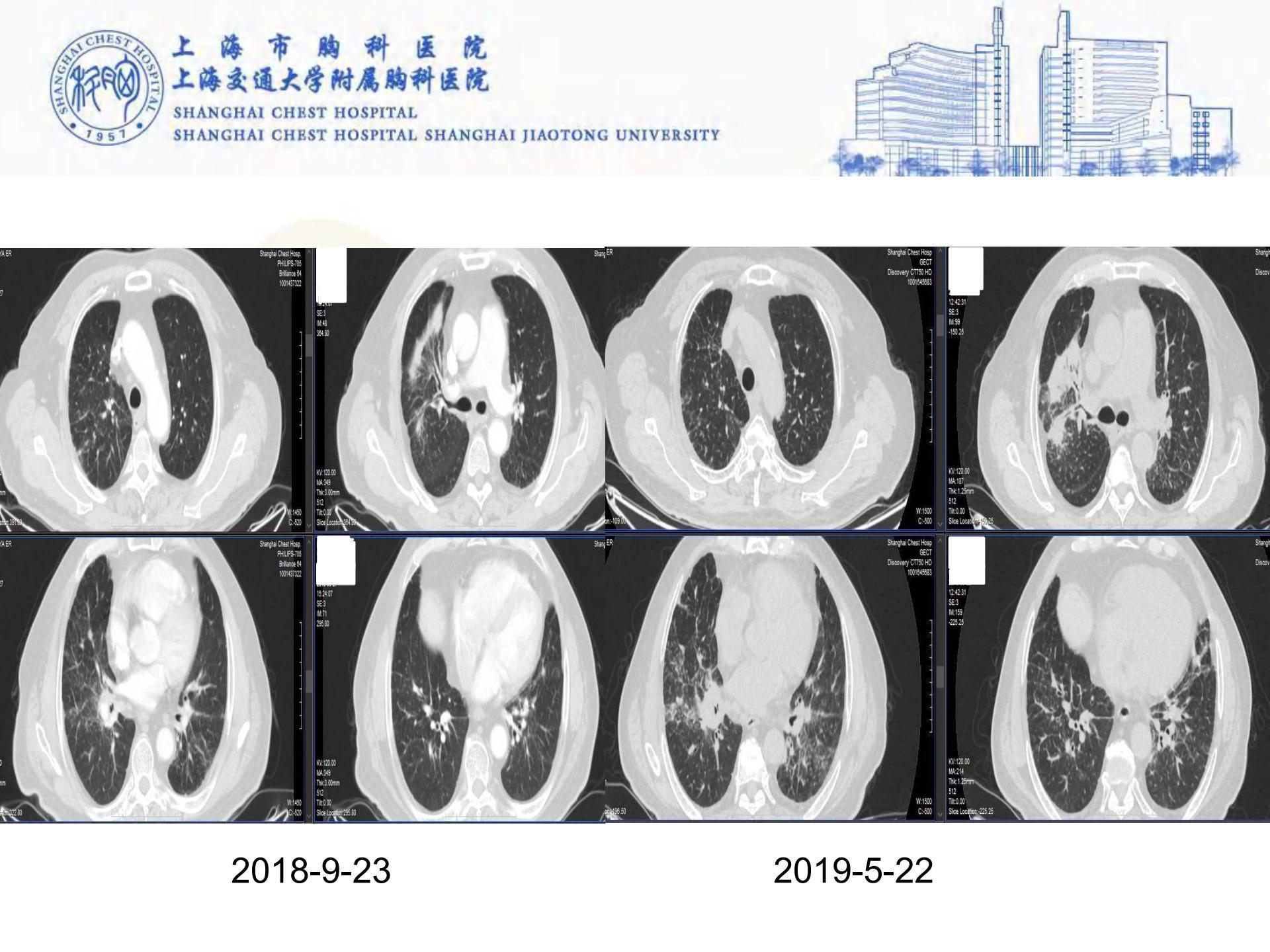 我是如何诊断间质性肺病