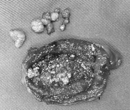 体检发现胆囊息肉怎么办 胆囊息肉 胆囊息肉