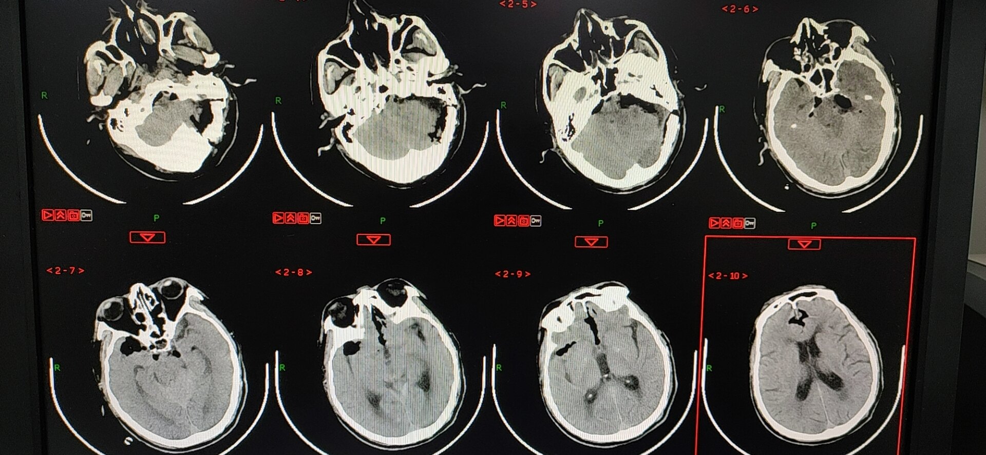 脑桥小脑角恶性肿瘤图片