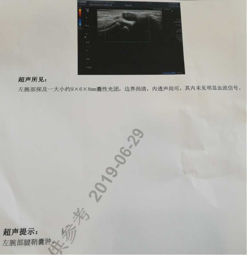 腱鞘囊肿_症状表现_治疗方式 - 好大夫在线