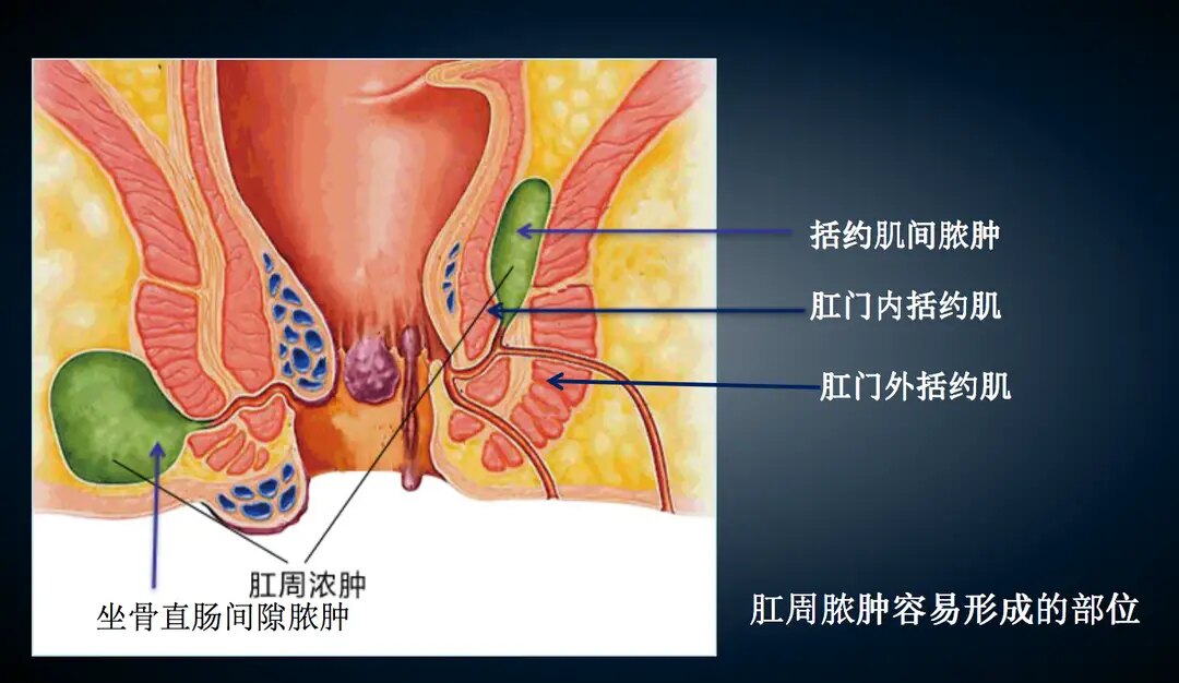 肛周脓肿的治疗肛周脓肿主要通过手术治疗,临床症状和体征决定了手术