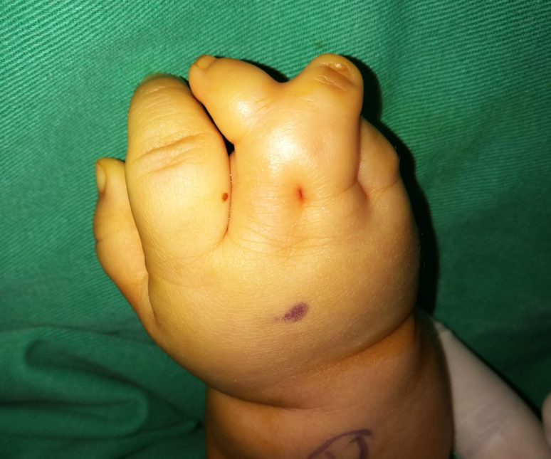 宝宝复杂并指治疗案例(一)_先天性并指多指畸形_治疗方式_日常注意