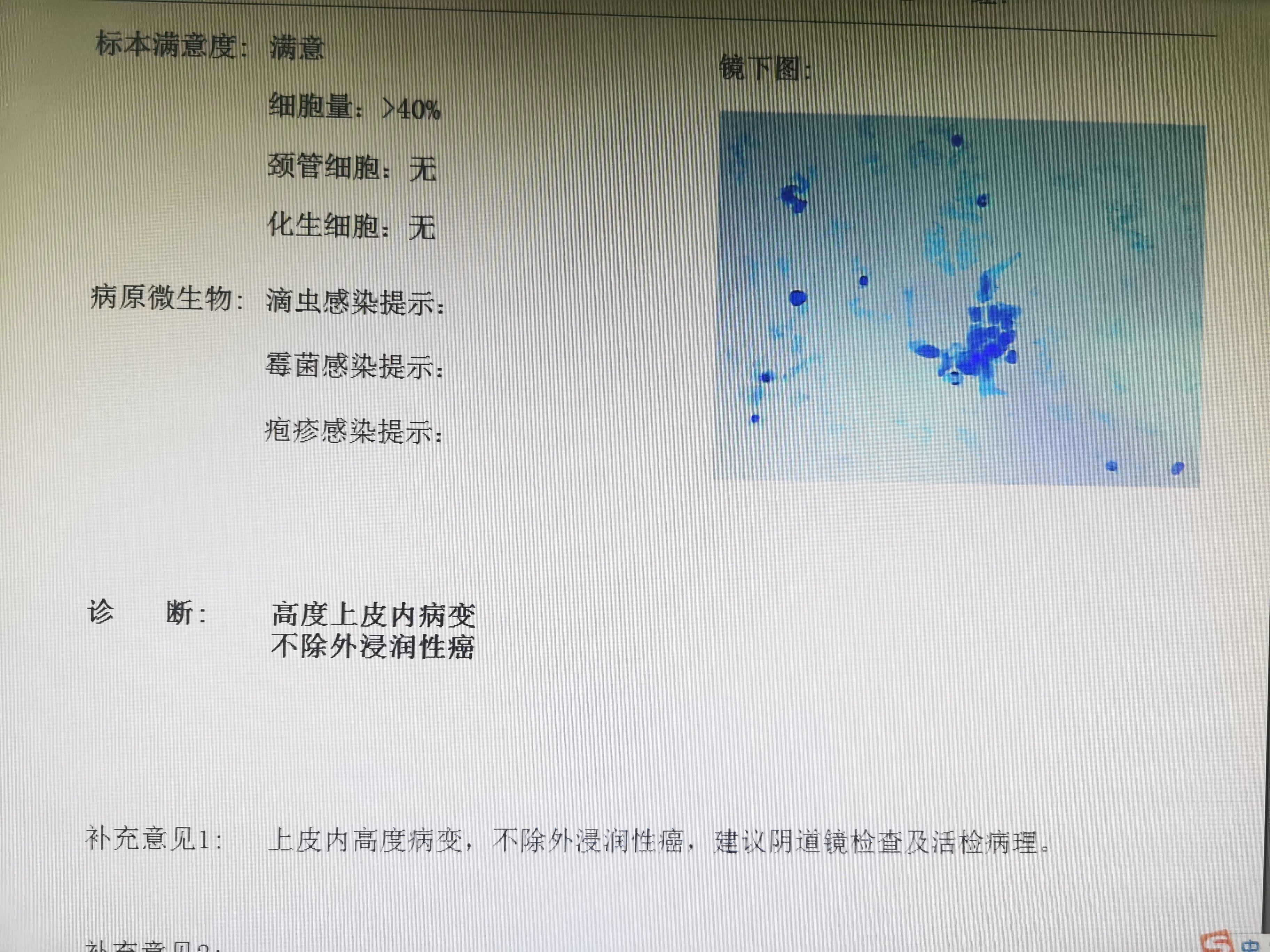 一分钟读懂宫颈液基细胞学tct报告