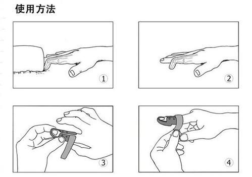 i区和il区伸肌腱损伤指的是锤状指.