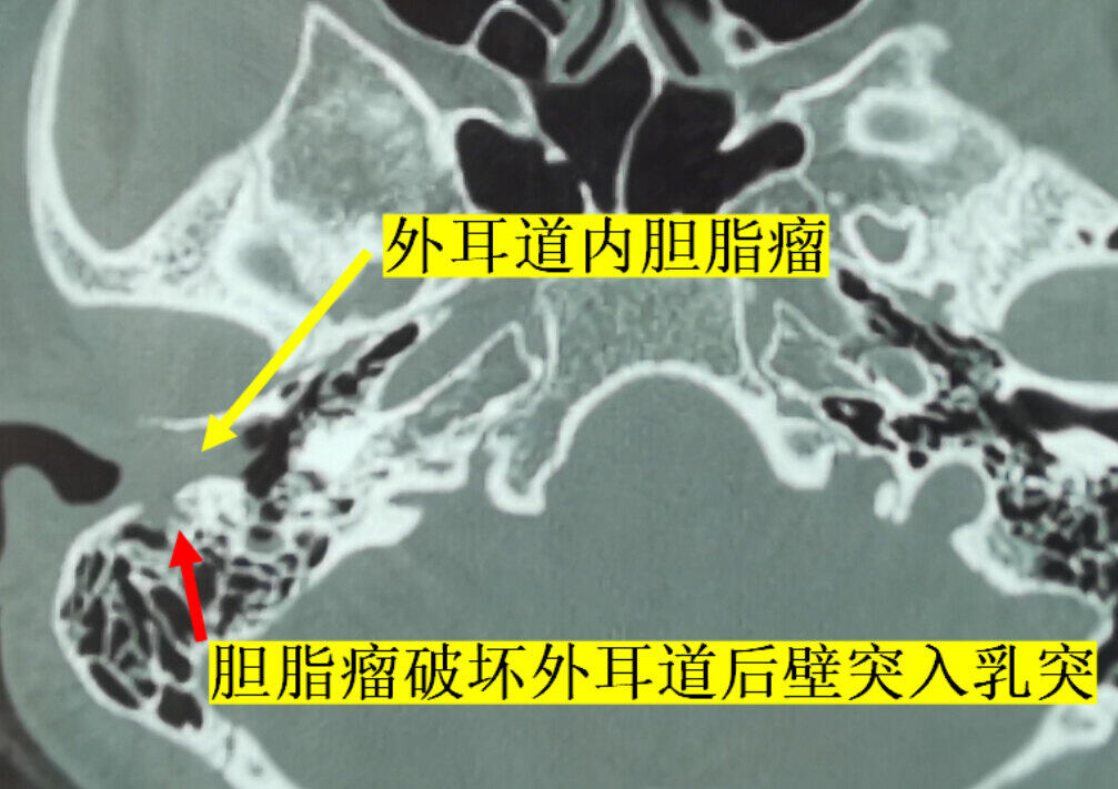 胆脂瘤导致骨质破坏