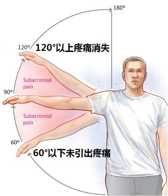 肩关节疼痛之肩峰下撞击综合征