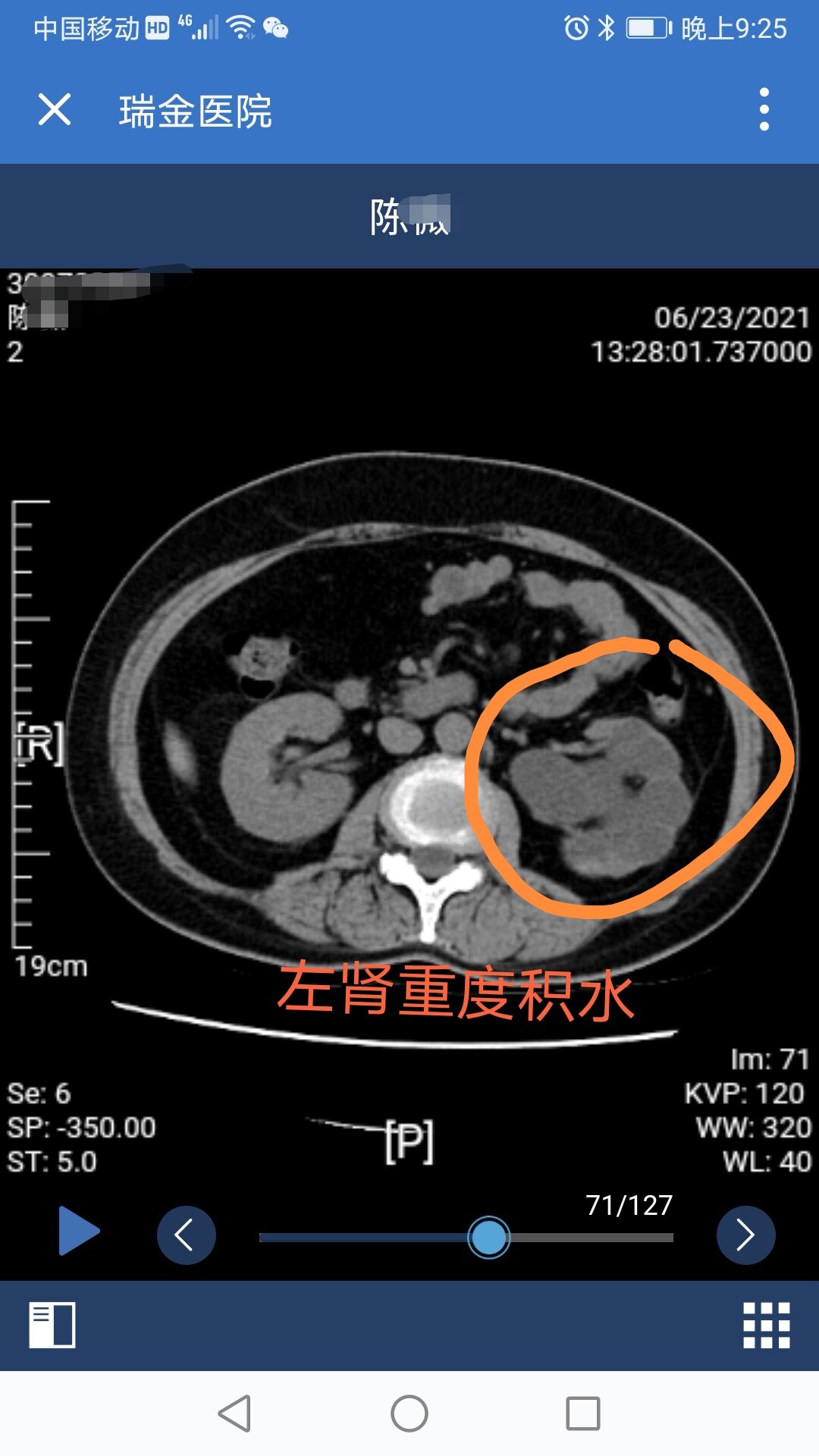 输尿管结石症状图片
