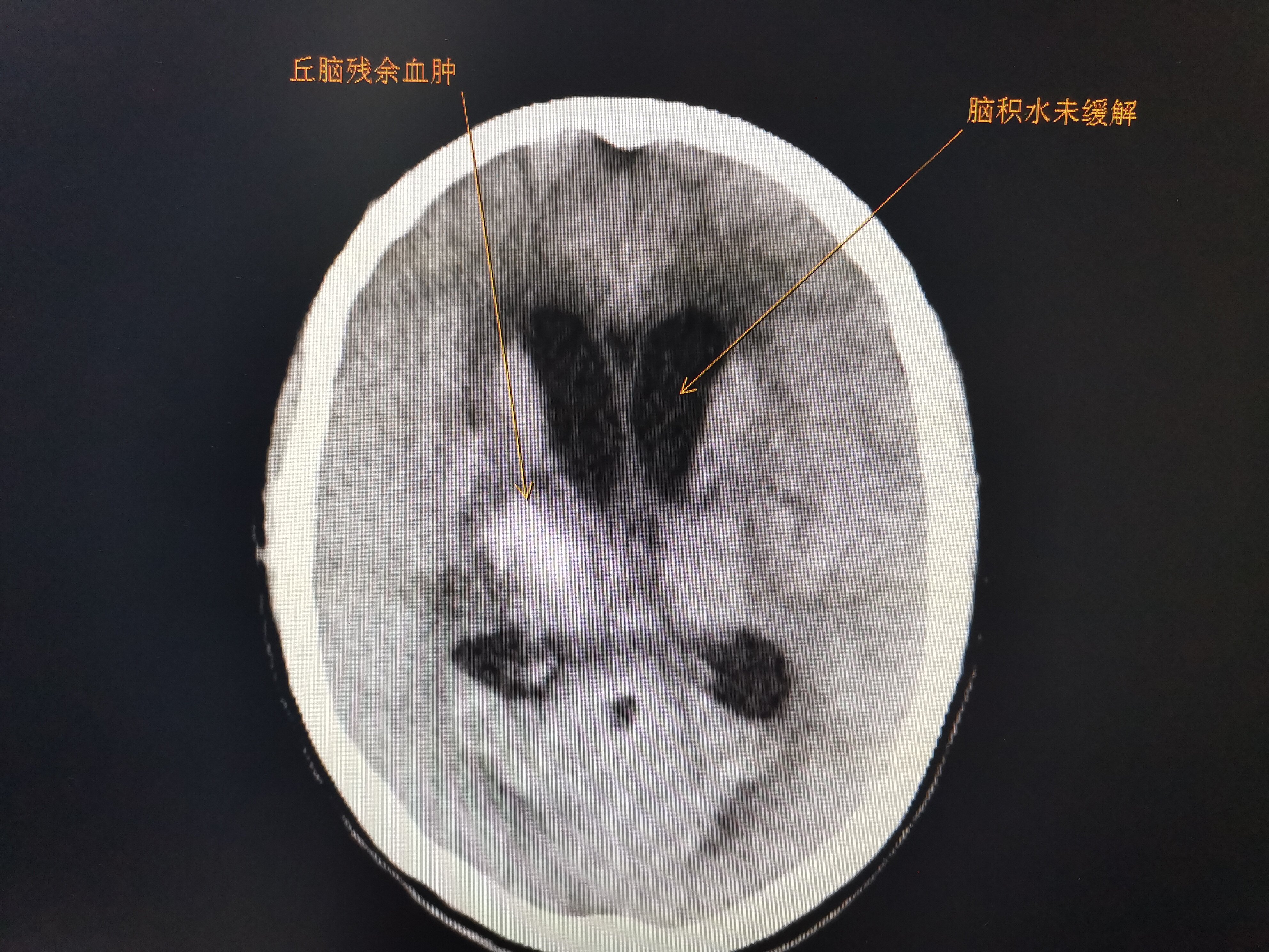 丘脑出血ct图片解说图图片