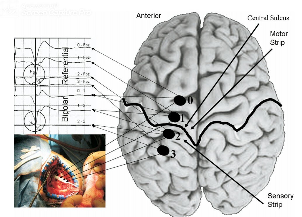 脑卒中后一侧肢体疼痛,偏身疼痛称为丘脑痛,丘脑痛怎么治疗_头痛_头痛