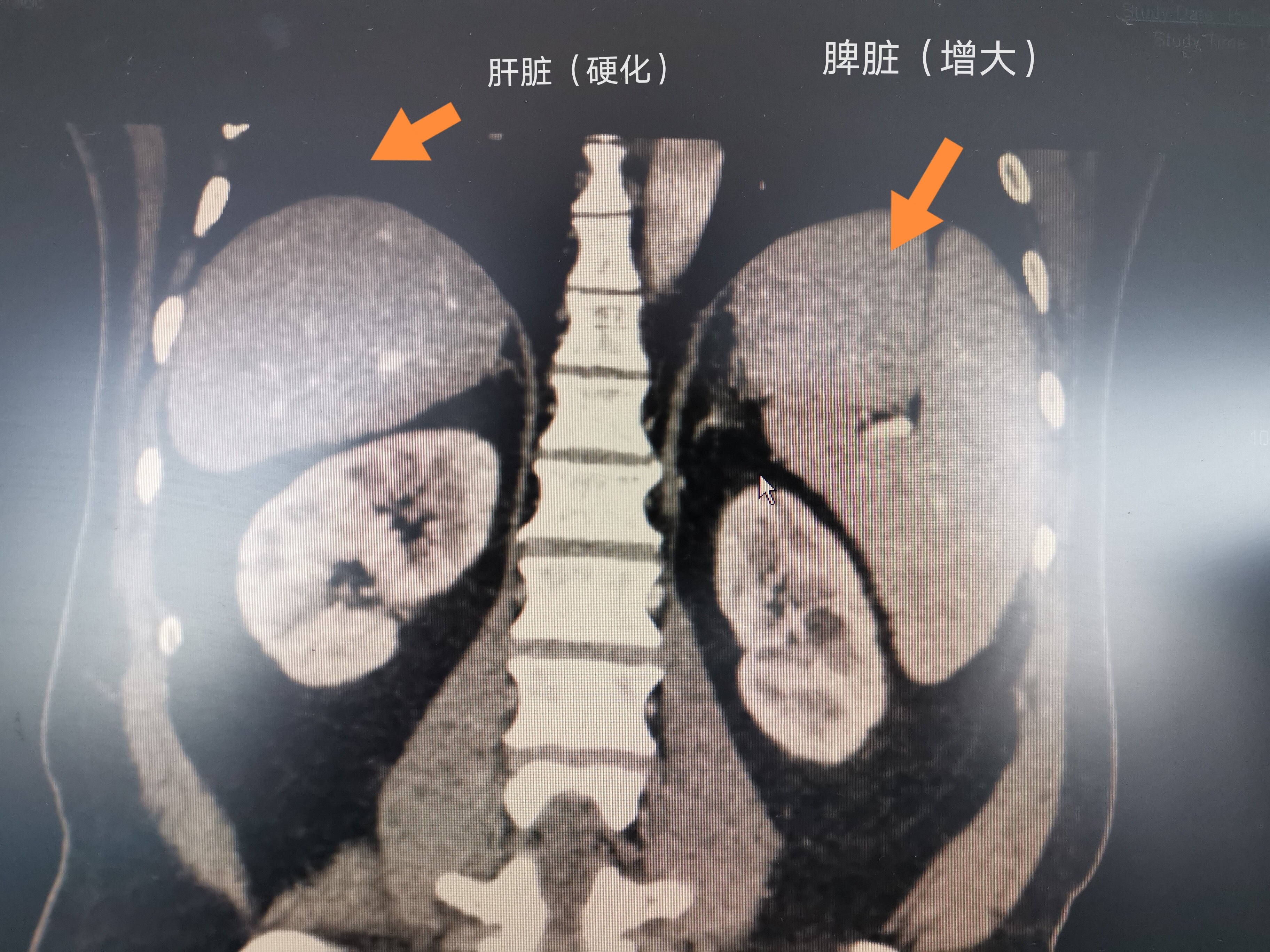 術前ct示肝硬化,脾大術前胃鏡是食管靜脈重度曲張,紅色徵( )術後2年餘