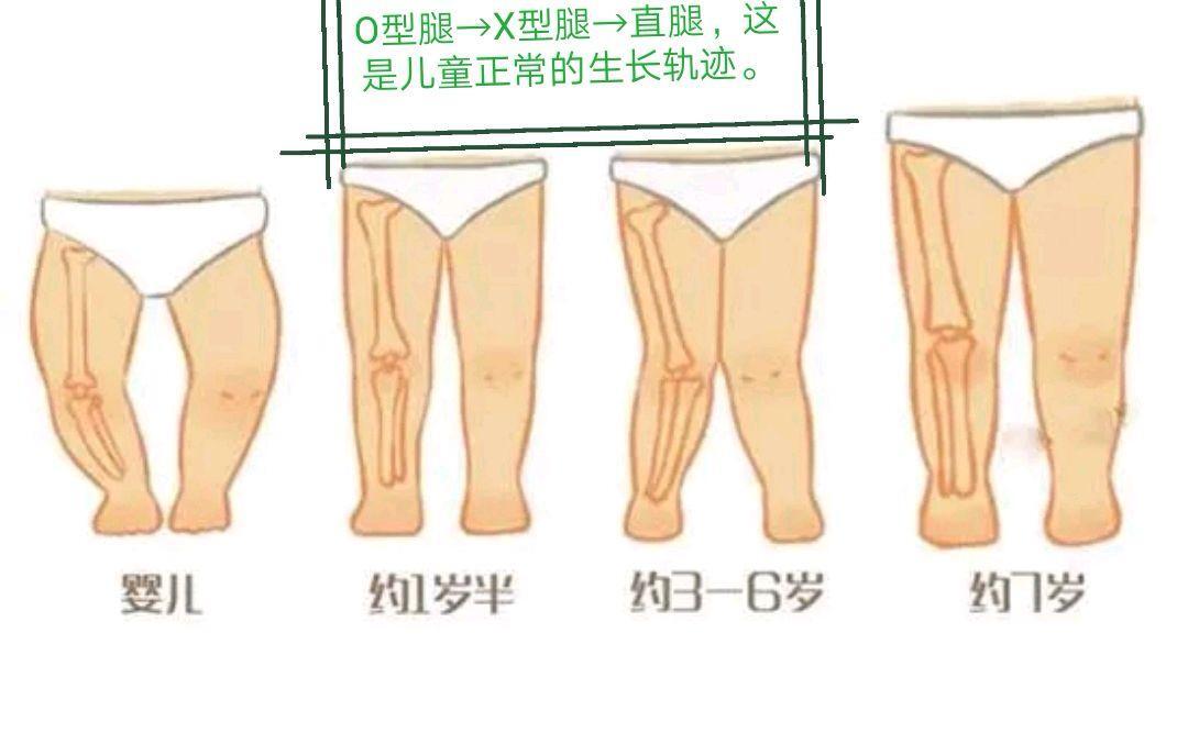 O型腿是怎么形成的图片