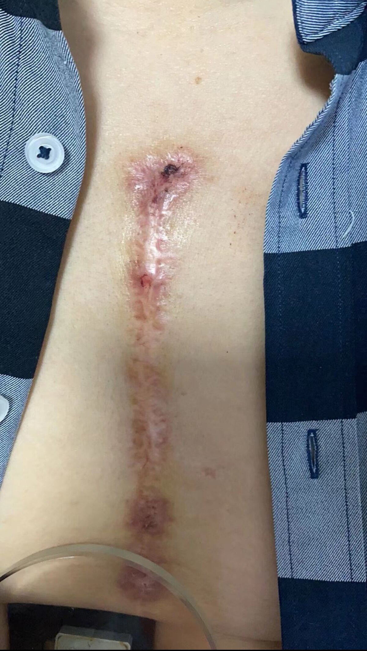 皮肤疤痕疙瘩/血管瘤放射性敷贴治疗知多少?