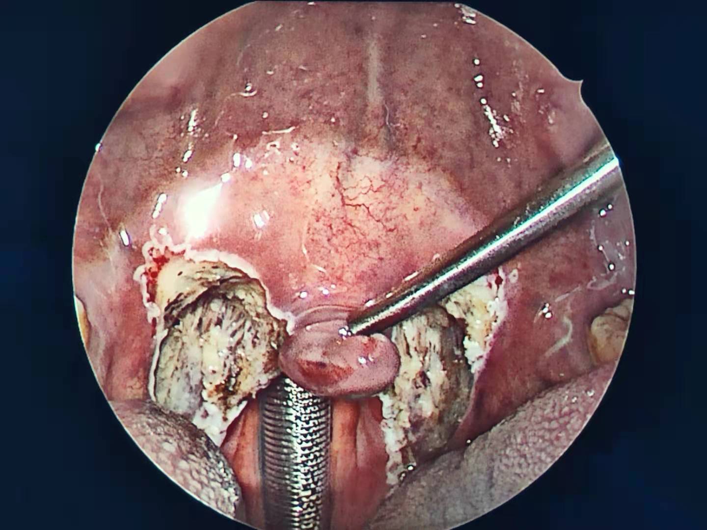 解惑答疑时间:很多患者咨询做了鼾症手术,过几年会复发,这是什么原因?