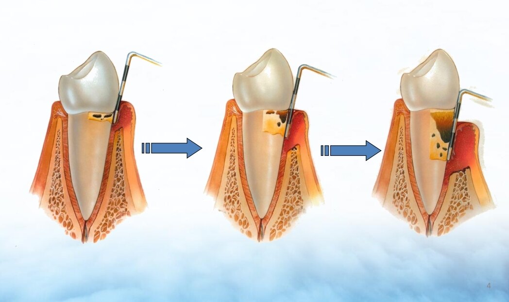 牙周袋的形成是一个缓慢发展过程,由浅到深
