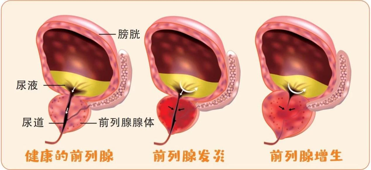 前列腺淀粉样小体图片