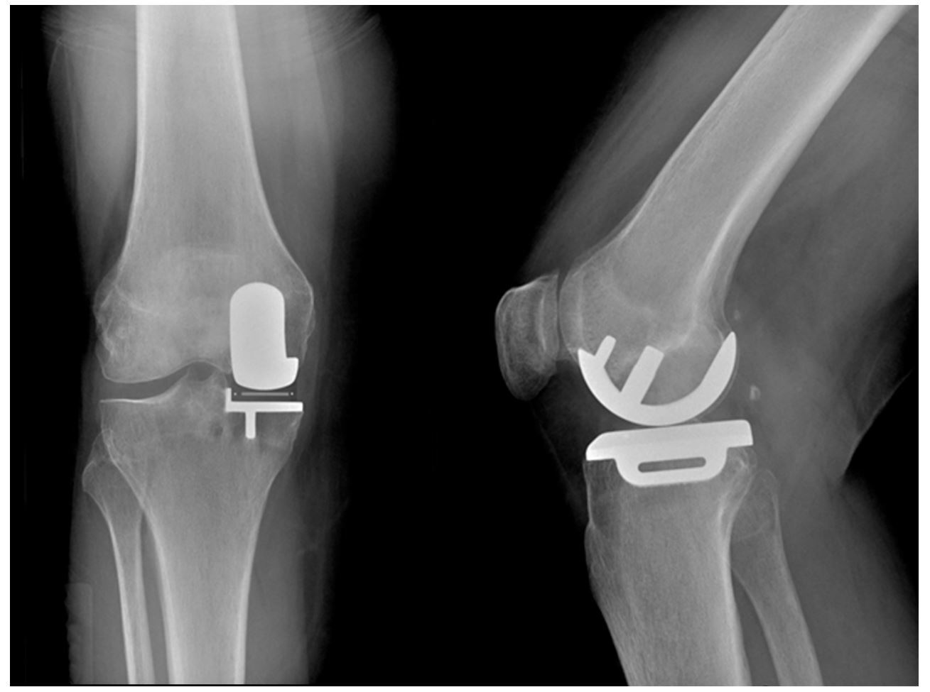 有些o形腿的膝关节骨关节炎,只用换一半关节就够了