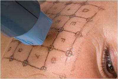 40-50岁面部松垂者,填充,拉皮,线雕,光电该如何选择?