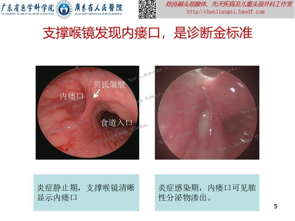 20240226-陈良嗣（省医ENT）-在这里，罕见的梨状窝瘘“不罕见”（羊晚约稿）_05.jpg