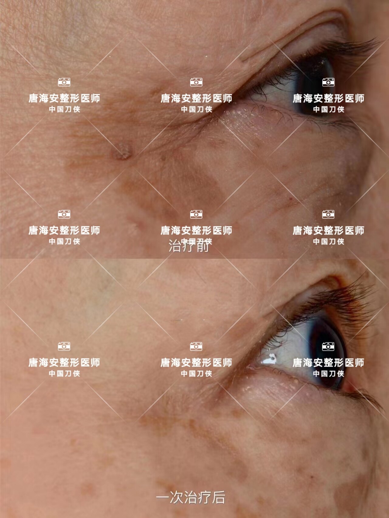 老年斑不是日晒班 老年斑