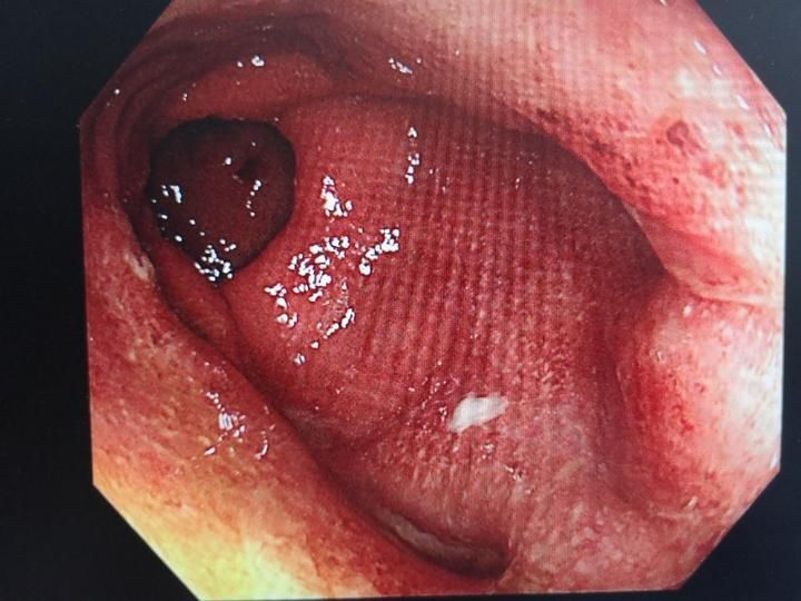 10复查肠镜提示:直肠距肛缘5cm以下可见黏膜充血水肿,伴薄白苔附着