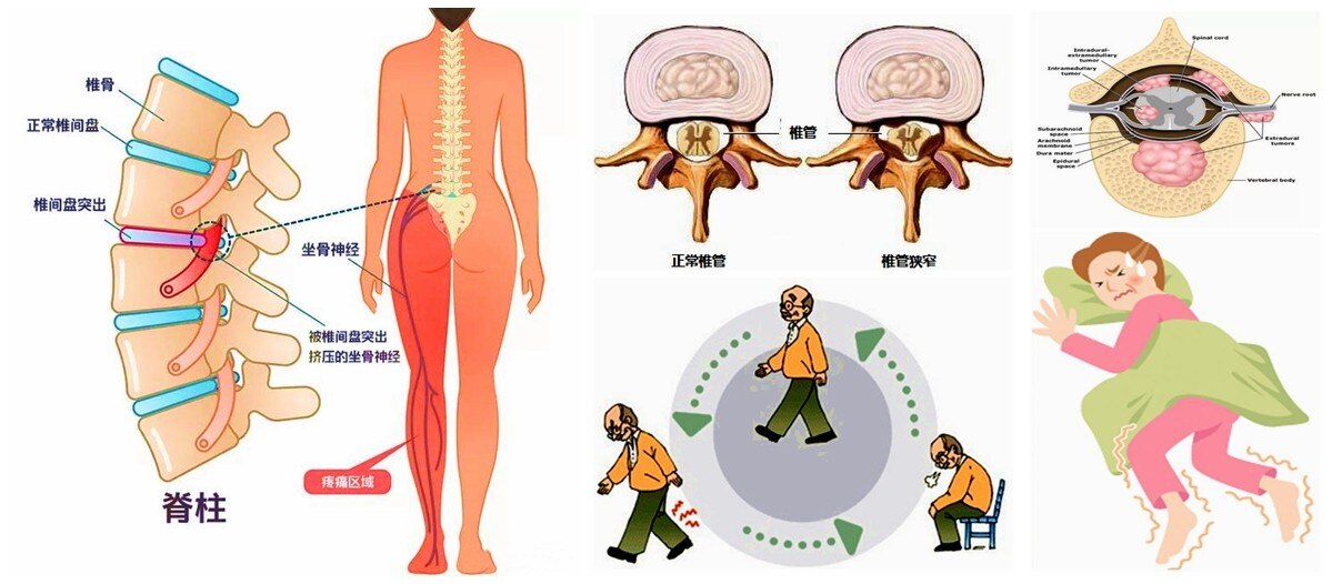 可能是腰出現了問題!_腰椎間盤突出 - 好大夫在線