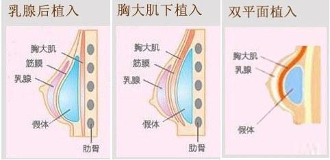 假體放置層次很重要,它影響術後乳房是否自然,恢復的快慢,包膜攣縮的