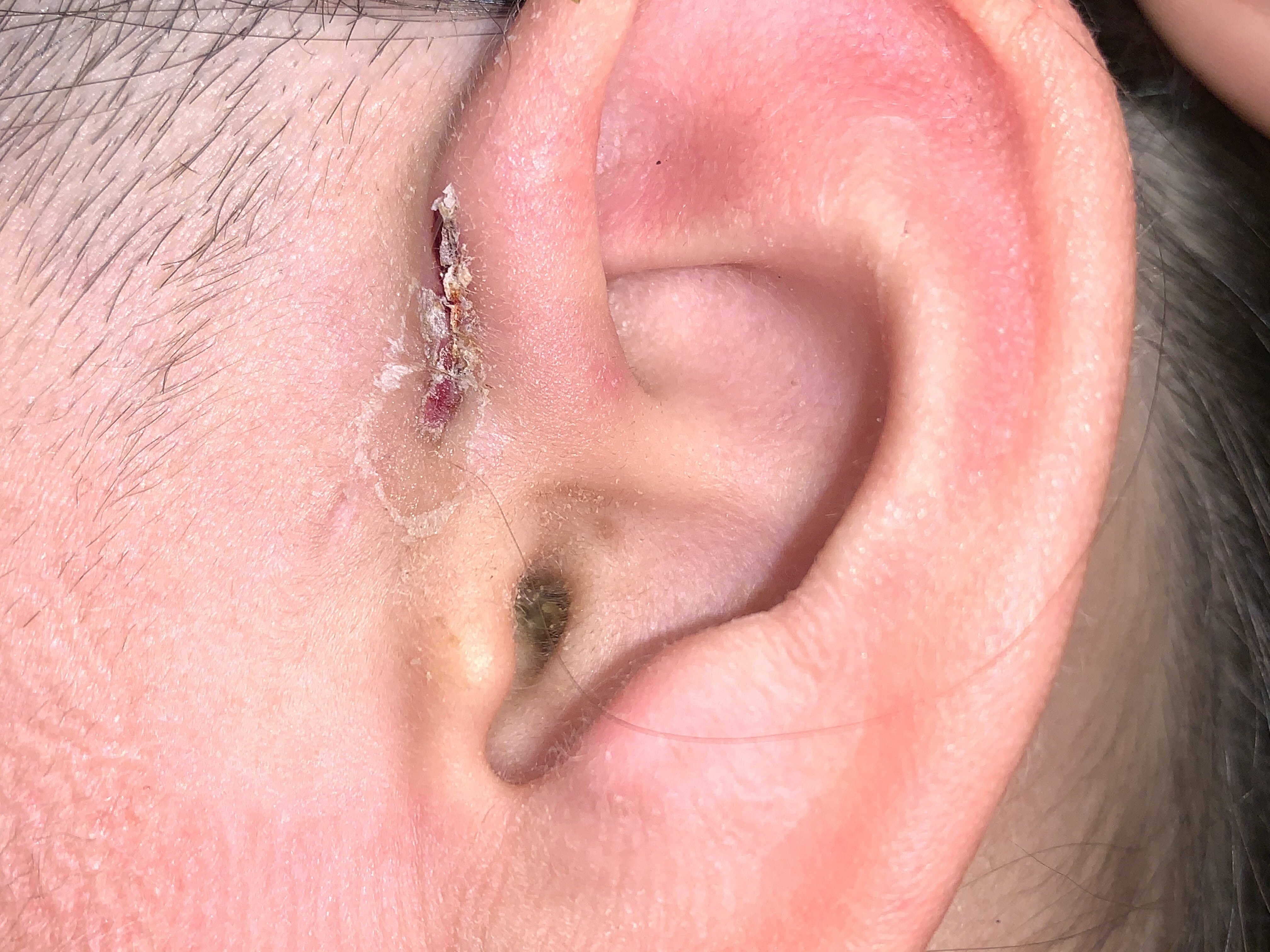 耳甲腔瘘管图片