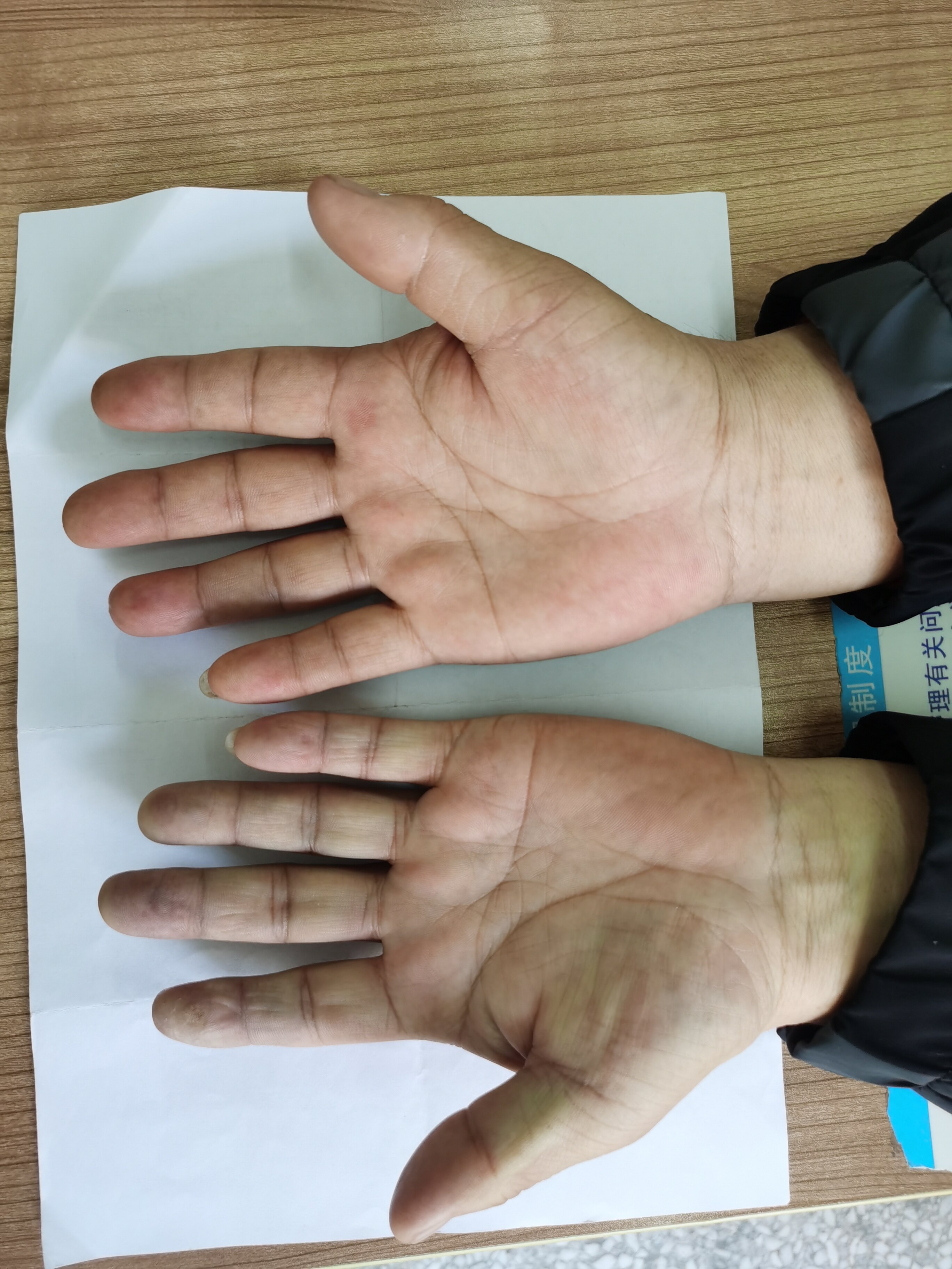 左上肢急性动脉栓塞,左手苍白,指端紫绀,脉搏消失,中西医结合防止坏死