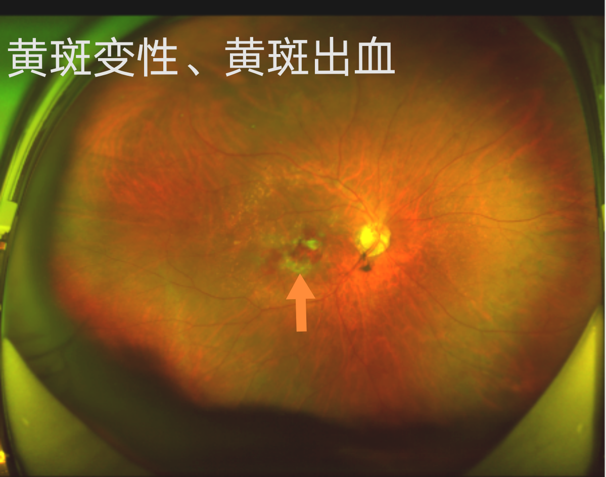 是由于糖尿病患者血糖控制不佳引起的眼底出血,黄斑水肿等一系列眼底