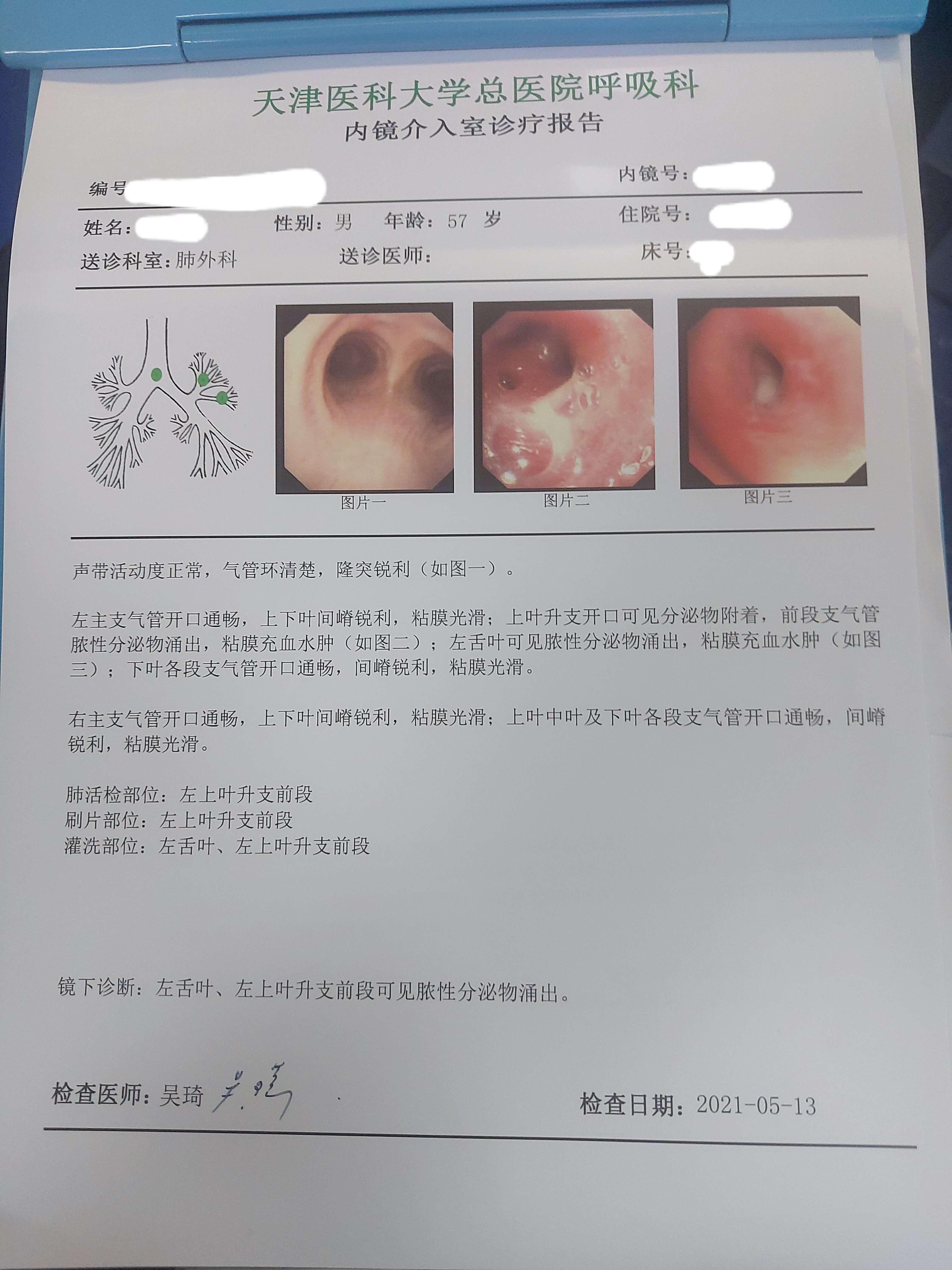 支气管镜肺癌报告图片图片