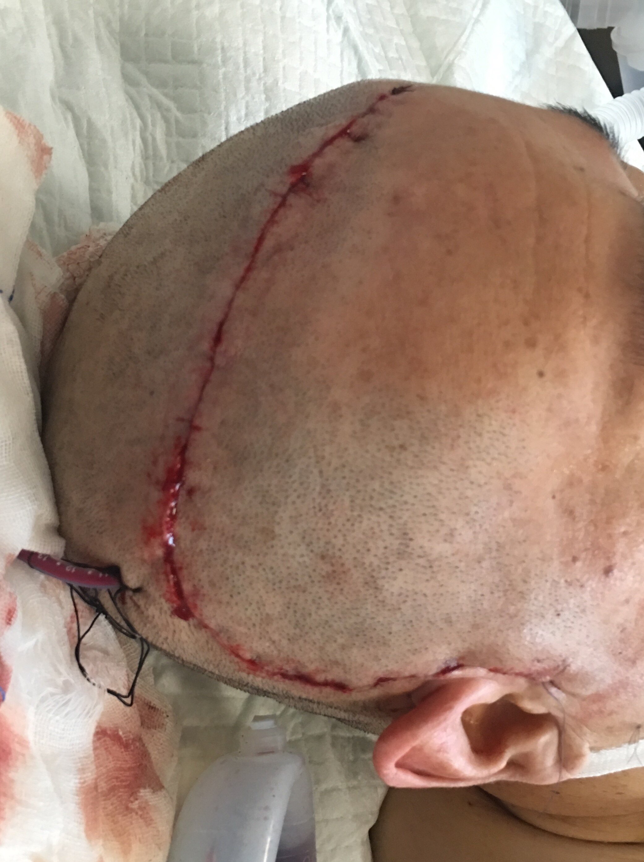 大切口也可微创伤——美容缝合的切口愈合 - 好大夫在线