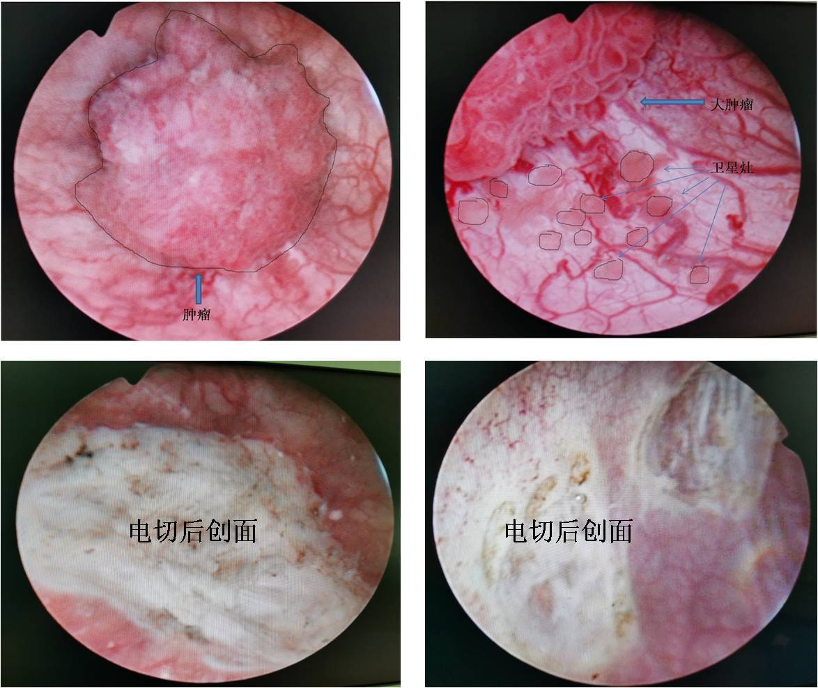 膀胱癌保膀胱微创手术实例(三)之大体积肿瘤