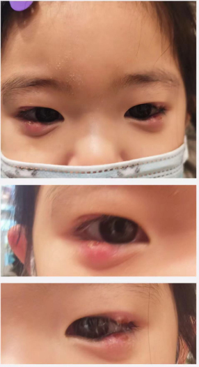 儿童多发性霰粒肿微创及脉冲光子治疗 北京美和眼科 张秀