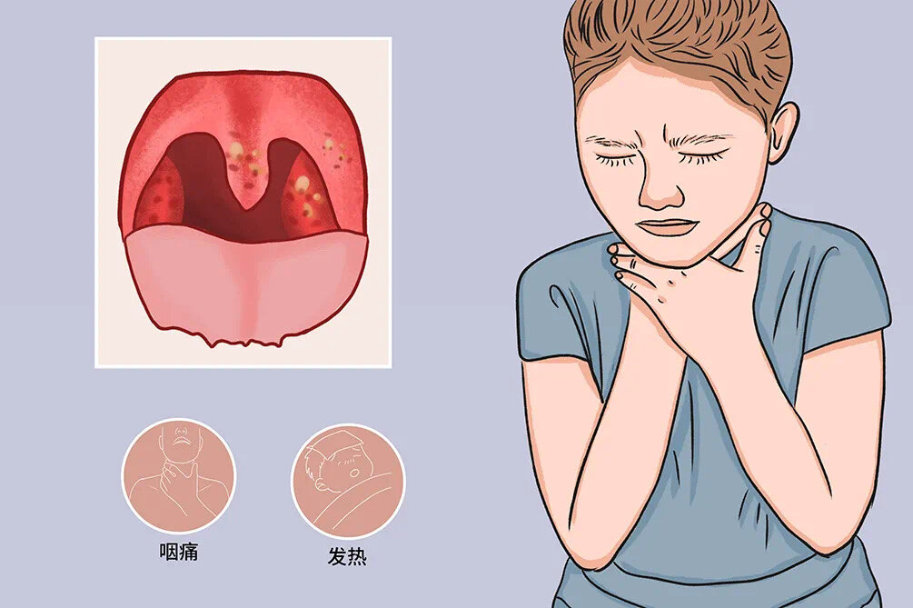 咽峡炎有哪些症状图片