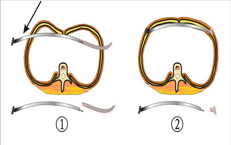 漏斗胸的手术方法_漏斗胸_治疗方式_治疗介绍 - 好大夫在线