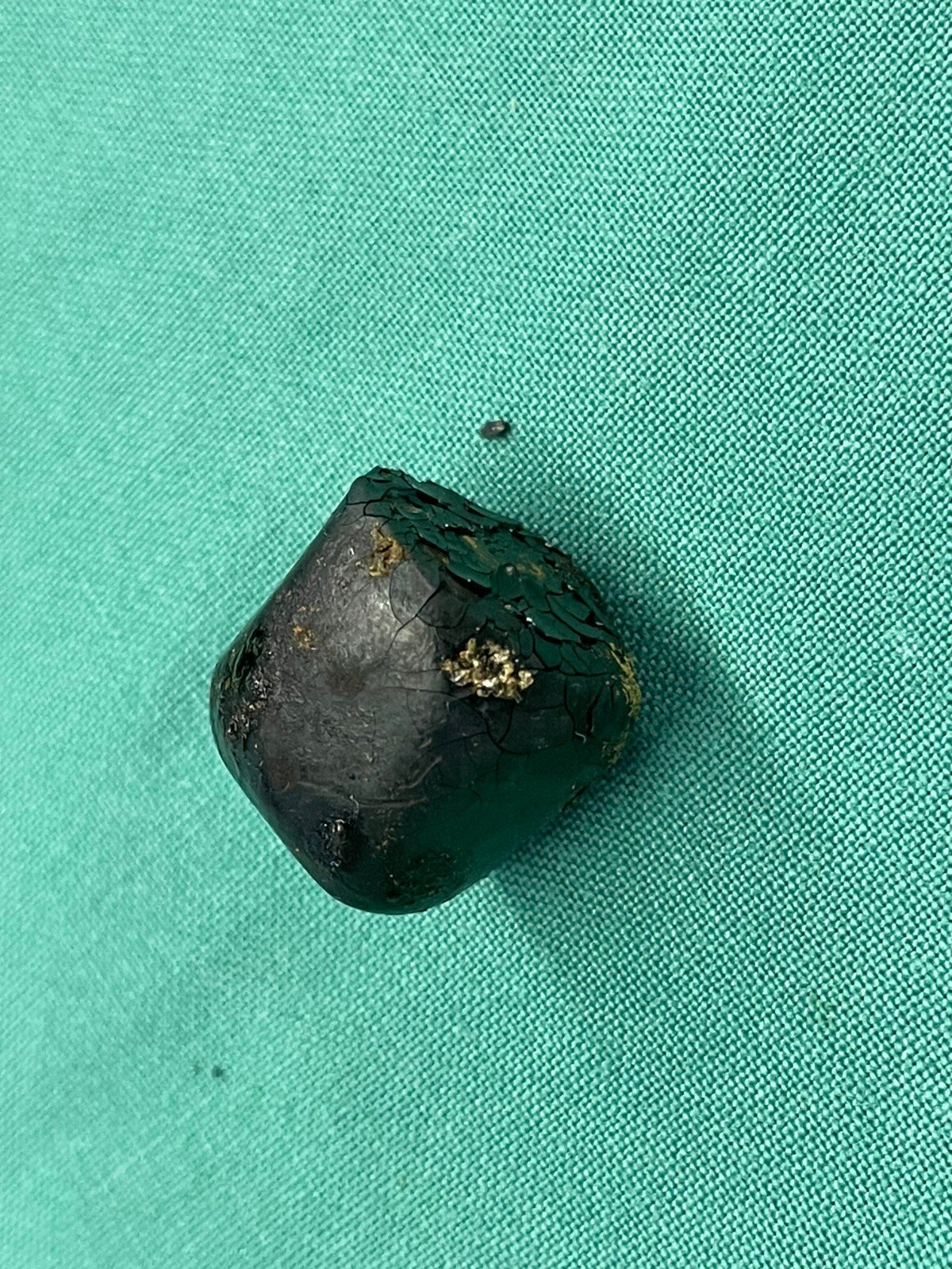 混合性胆结石,居然长这样