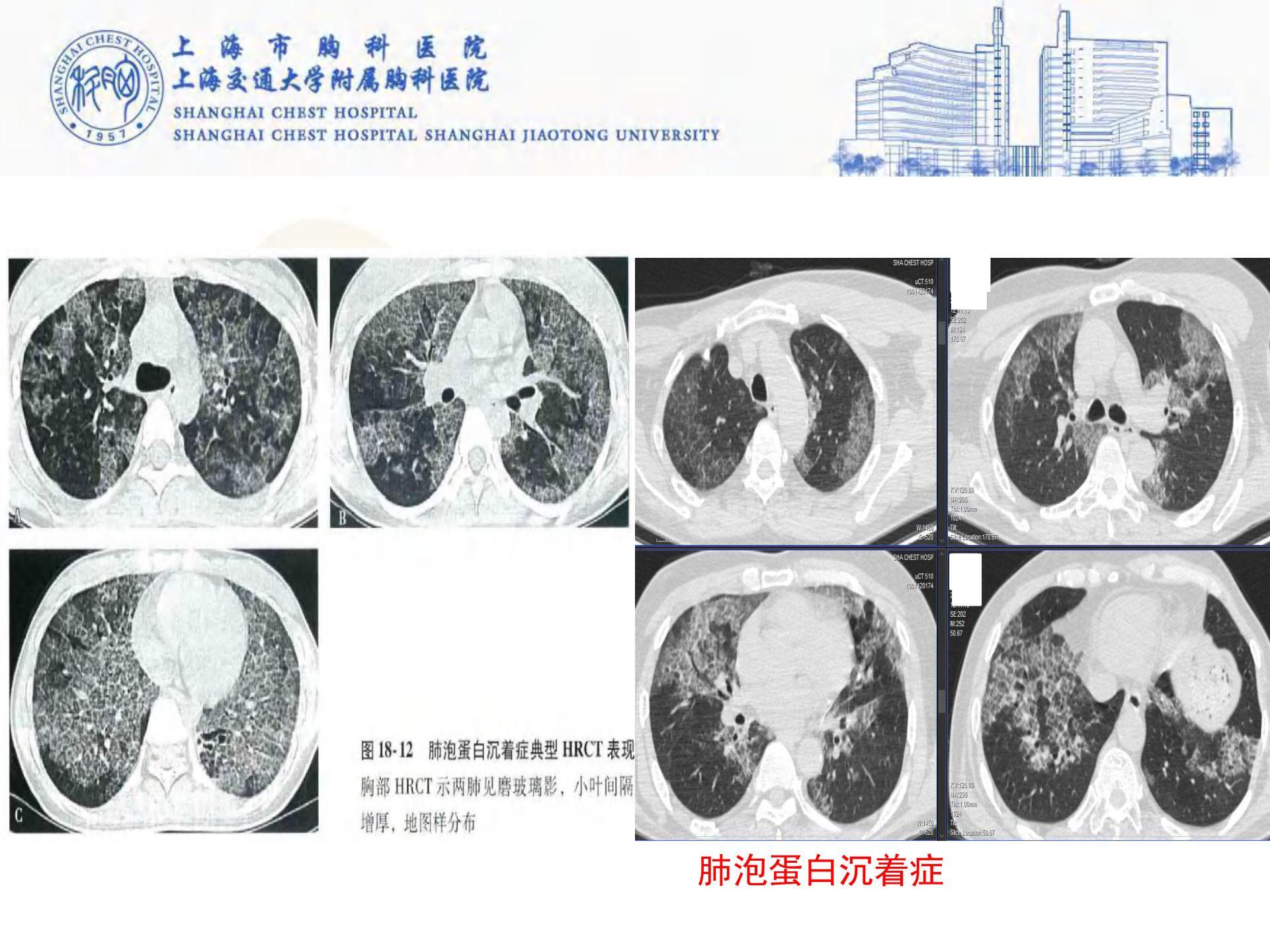 我是如何诊断间质性肺病