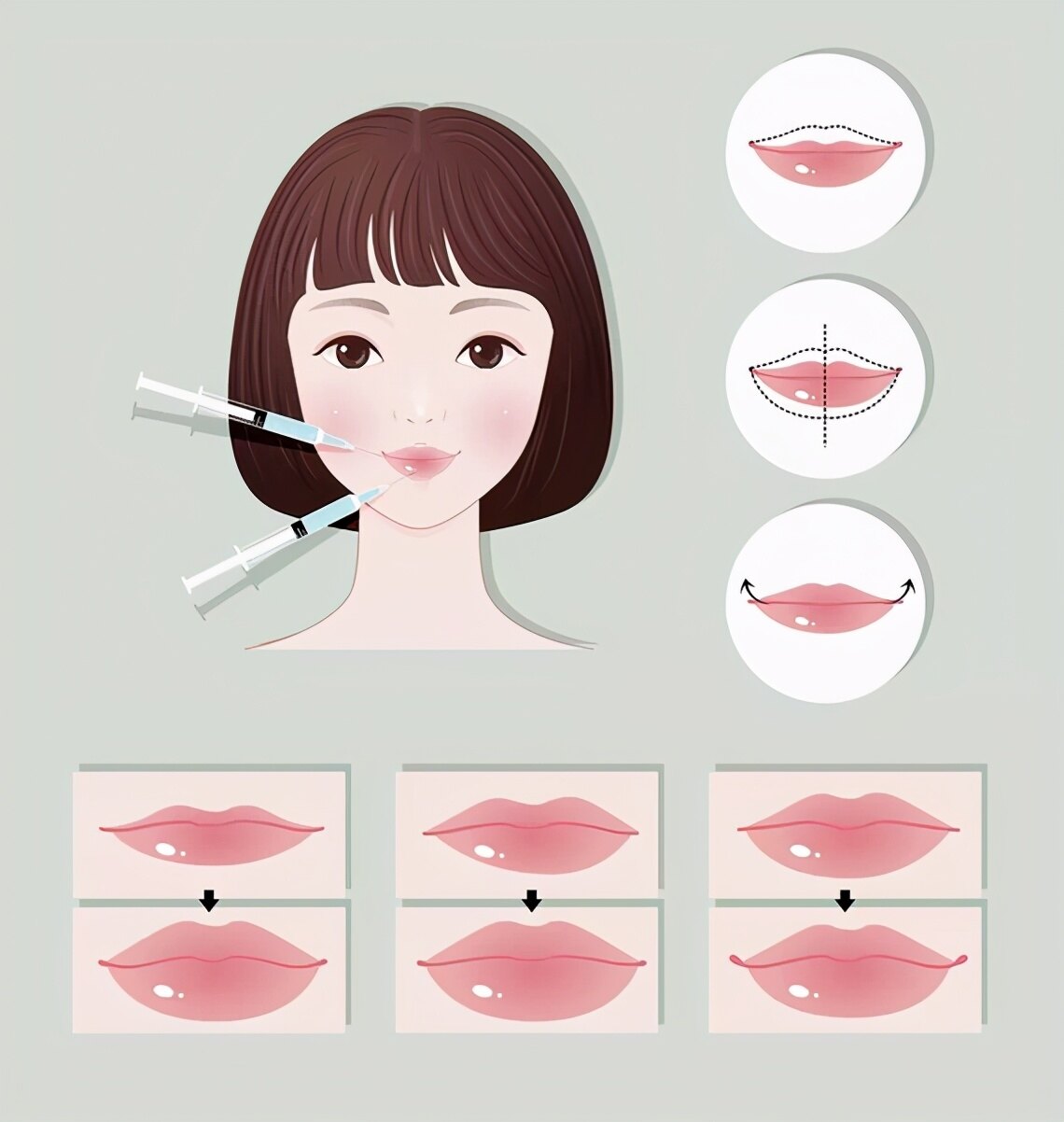 余文林博士为您解疑:m唇术后拉扯感强,合嘴困难,要进行m唇修复吗?