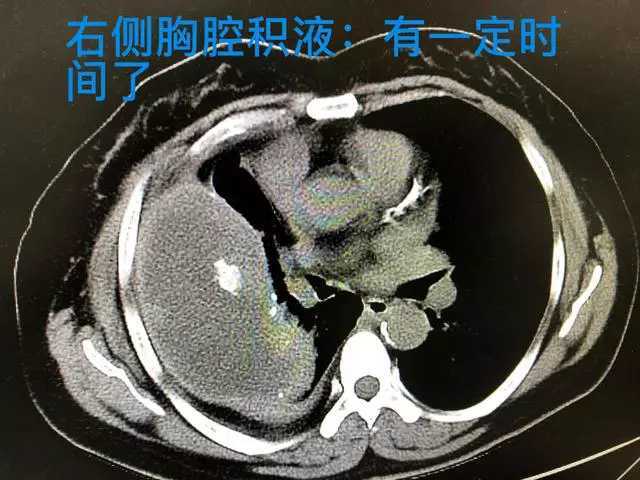 簡述胸腔積液的治療 - 好大夫在線