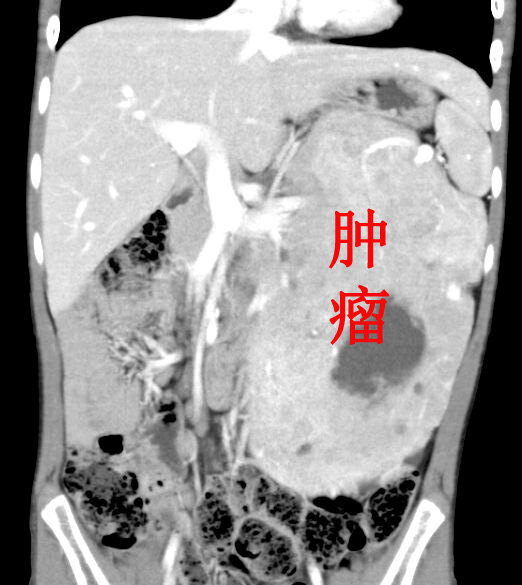 手术切除儿童胰腺腺泡细胞癌 - 好大夫在线