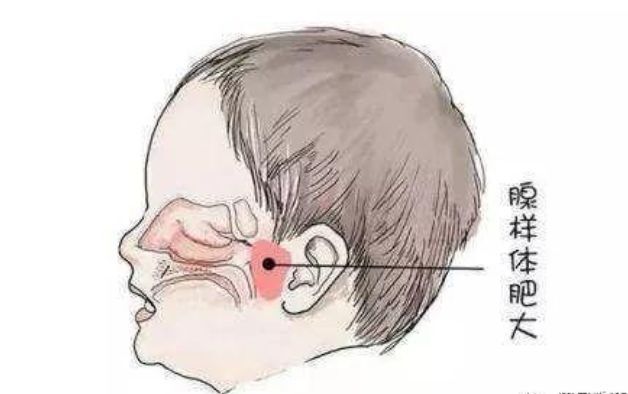 儿童鼻咽部腺样体增生图片